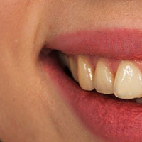 Les différentes techniques pour avoir les dents plus blanches