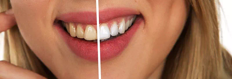 Les différentes techniques pour avoir les dents plus blanches